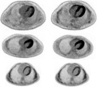 A novel method in myocardial injury risk stratification using intravenous fat emulsion as sole rapid preparation for unfasted patients to suppress myocardial 18F-fluorodeoxyglucose uptake for optimal cardiac PET imaging: a proof-of-concept randomized-crossover trial